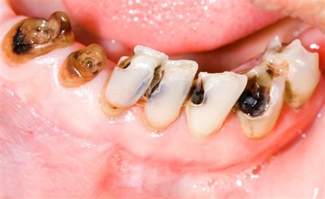 how to know if tooth is decaying