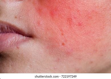 Face Young Woman Rash Allergic Reaction Stock Photo 722197249 ...