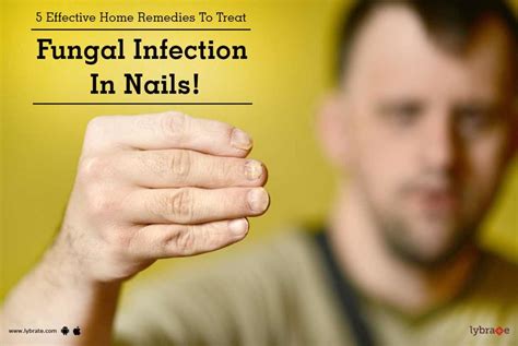 5 Effective Home Remedies To Treat Fungal Infection In Nails! - By Dr ...