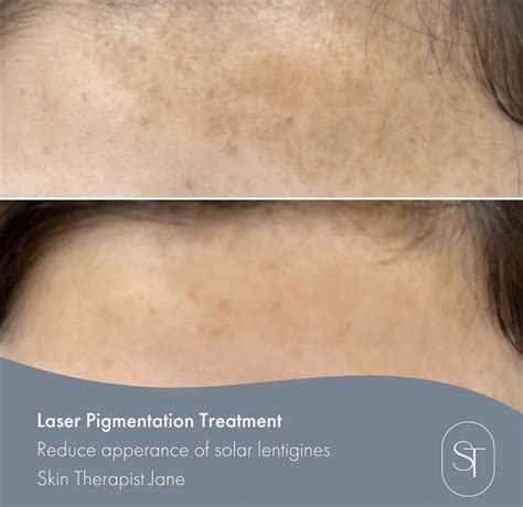 laser pigmentation age spot removal skintech