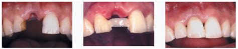 Root Canal Alternatives | Holistic Dental Treatment | Pure Holistic Dental