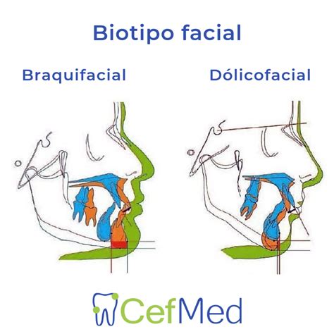 Biotipo Facical y sus distinas variables de Biotipo - CefMed