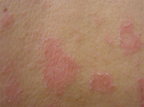 Pityriasis Rosea Swimming Pool at Harold Cheever blog