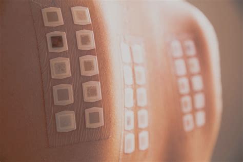 Epicutaneous tests - DERMAREVOLTA