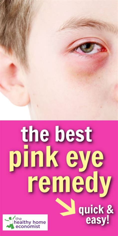 Pinkeye: The Fastest and Easiest Home Remedy | Pinkeye remedies, Pink ...