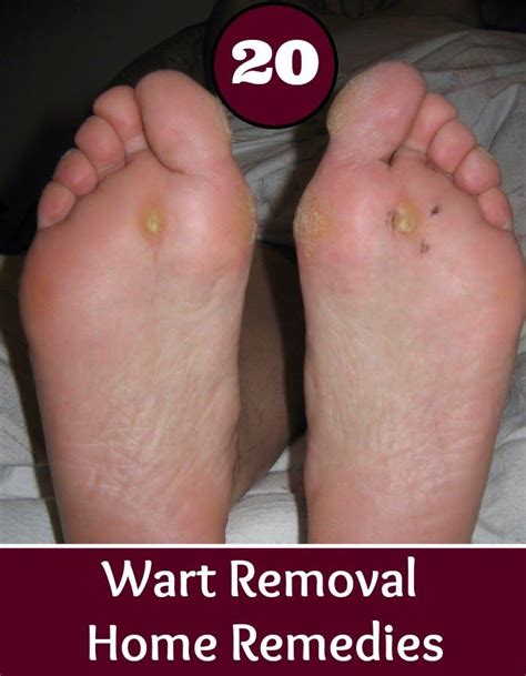 hometoday: Home Remedies For Wart Removal