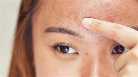 3 Reasons Why Your Skin Is Breaking Out | Hero Cosmetics