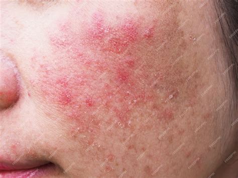 Premium Photo | Red rash on young woman face, Itchy and allergic skin ...