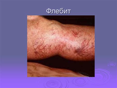 Хирургические инфекции - online presentation