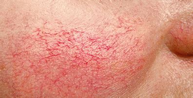 diffuse redness skin treatment australian skin clinics