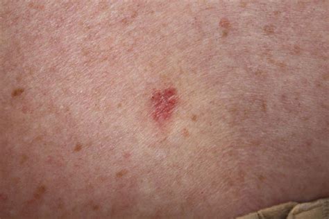 Basal Cell Skin Cancer Treatments Boston & Wellesley | Krauss Dermatology