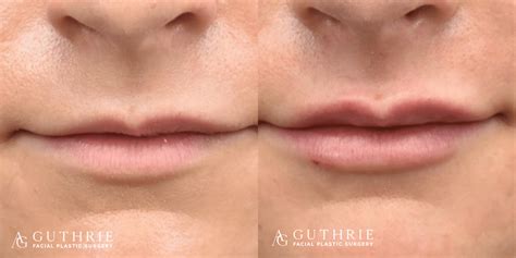 Lip Fillers | Guthrie Facial Plastic Surgery TN