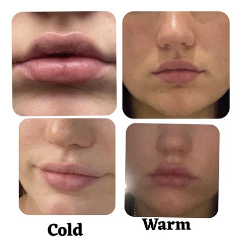 filler virgindouble lip lines rplasticsurgery