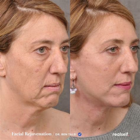 Top Plastic Surgeons Analyze Jen Psaki's Possible Procedures Image 4