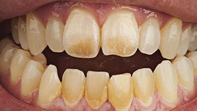 Sigara zararları nelerdir? - DentaCenter