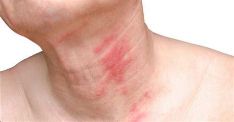 dermatitis eksim beritalimacom