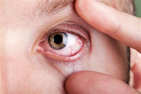 What Is Pink Eye And Is It Contagious?