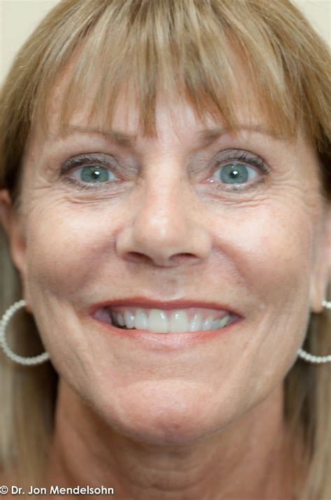 Eyelid Services – Advanced Cosmetic Surgery & Laser Center