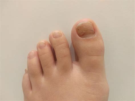 nail fungus      rnailfungus