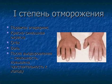 Холодовая травма. Отморожение - презентация онлайн