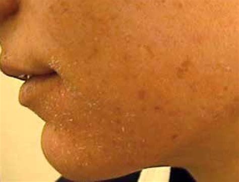 Dryness of the skin associated with isotretinoin therapy