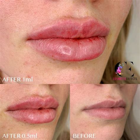 ml  ml  lip fillers whats    lip fillers lips