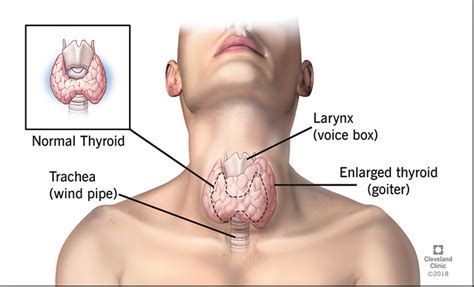 What Causes Goiter? Let's find out! - MBBCH Health Encyclopedia