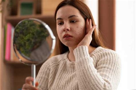 Чем лечат купероз на лице