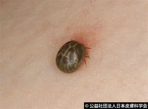 【発疹・湿疹など症状写真あり】ダニに刺された跡の特徴や症状・対策・あせもとの見分け方 - くらしのマーケットマガジン