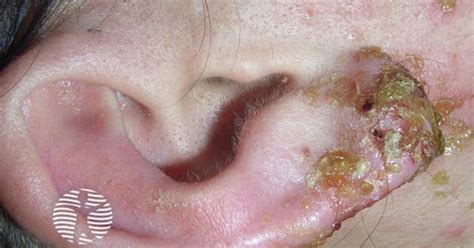 Infected earring reaction image