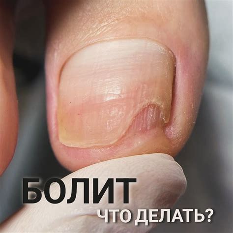 ПОДОЛОГИЯ МЕДИЦИНСКИЙ ПЕДИКЮР | Что это у меня?!😱 Пьезогенные папулы ...