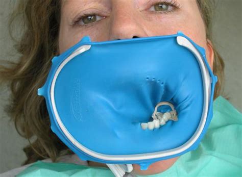 Co to jest koferdam? - Dentonet