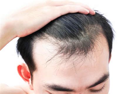 8 Ayurvedic Tips for Male Pattern Baldness Treatment