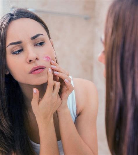 Staph Infection On Lips