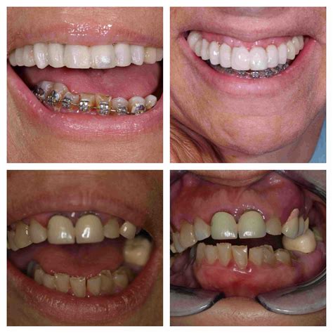 Advanced implant prosthodontics - Immediate loading - Dental Aesthetics