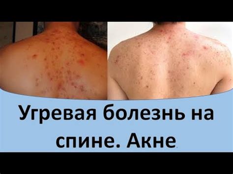 Угревая сыпь на спине - YouTube