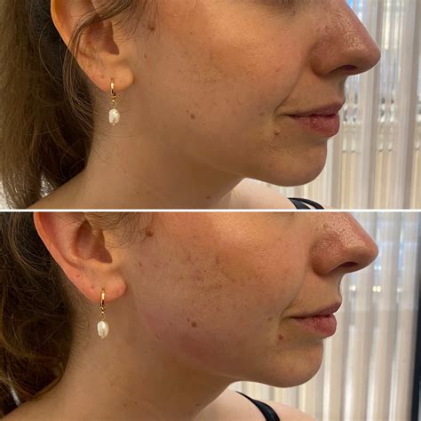 chubby face 1ml jawline filler 8