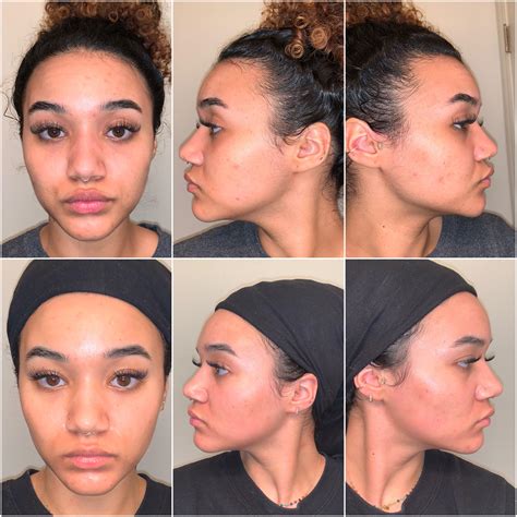 tazorac before and after wrinkles 3