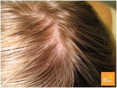 Skin Cancer on Scalp