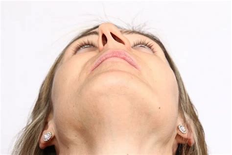 fixing deviated septum  consequences