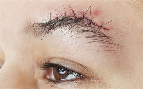 10 Ways To Remove Stitch Marks On Your Face! – SkinKraft