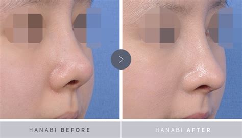 Upturned nose correction with rhinoplasty – HANABI RHINOPLASTY CLINIC