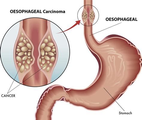 ESOPHAGEAL CANCER: TYPES, SYMPTOMS, STAGES, AND MORE - Chiid Health
