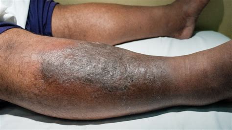 Superficial Blood Clot In Leg
