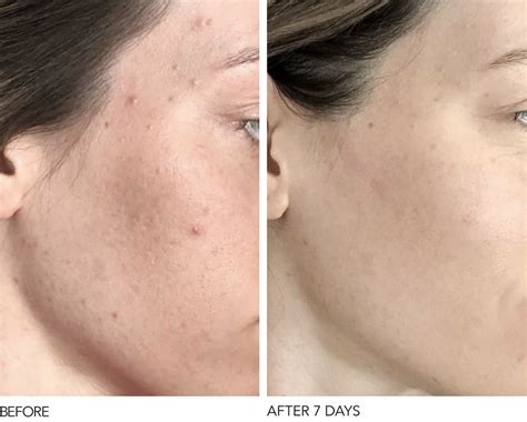 28 Skincare Products With Dramatic Before & After Photos