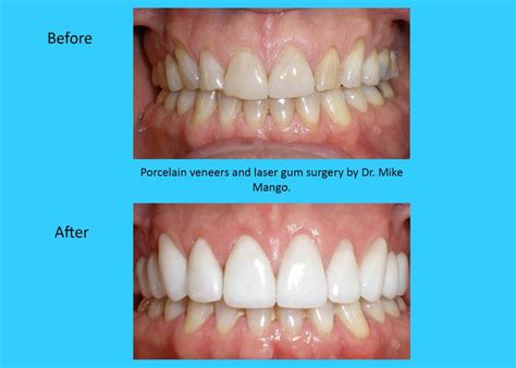 Laser Gum Surgery Before And After