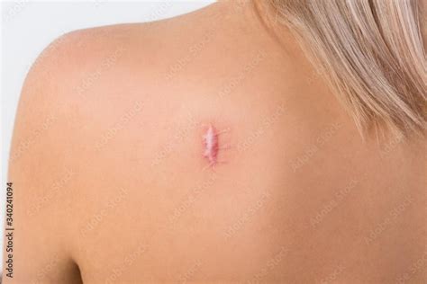 What Is a Keloid Scar?: Raveco Medical: Obstetrics & Gynecology