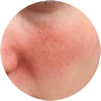 Ruddy skin: What causes ruddy face and its treatments | The Pink Foundry