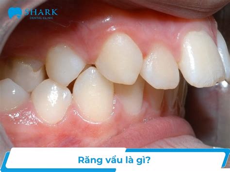 gai  rang khenh  ben   nghia gi