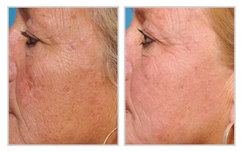 skin treatments halo laser treatment downtime aftercare during the